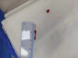 留置针软管遗留患儿体内五年，医疗事故的警示