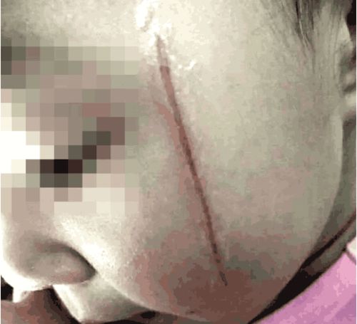 悲剧瞬间，18岁女孩关煤气发生爆炸，面部严重受损需植皮