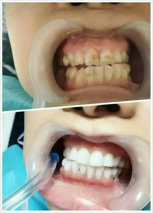 牙缝异味克星，全面解析牙缝臭的成因与解决方案