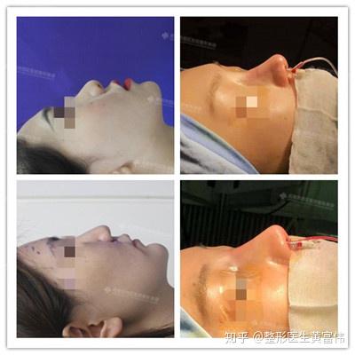 揭秘鼻子里的小秘密，疼痛、结痂与出血的真相