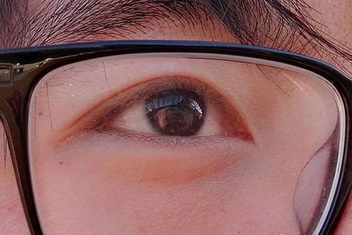 揭秘眼球血丝多的真相，原因、影响及应对策略