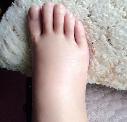 健康速递脚肿了怎么办？专家教你快速消肿的秘诀！