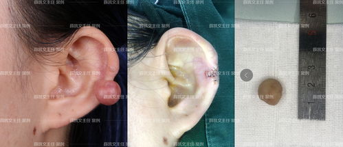 耳朵后面长了疙瘩，原因、诊断与治疗指南