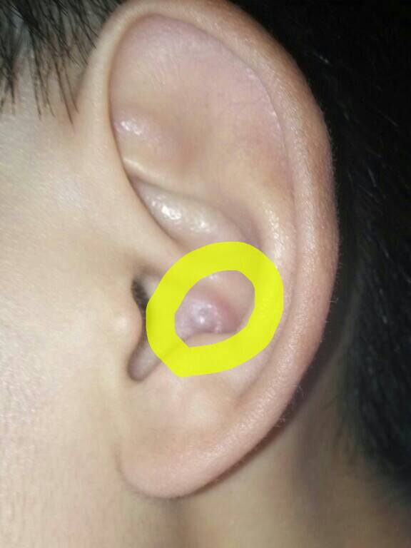 耳朵后面长疙瘩，揭秘那些小疙瘩背后的秘密