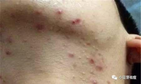 揭秘，身上长疙瘩的真相与应对策略