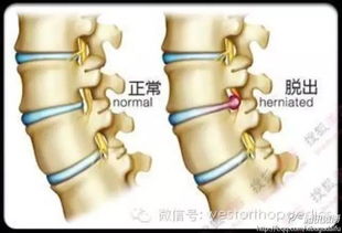 腰椎间盘突出的封闭疗法，疼痛的终结者