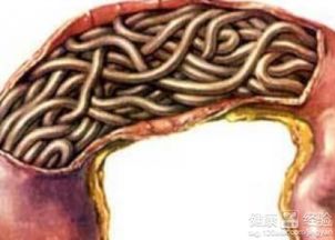 全面了解蛔虫感染，症状、诊断与治疗方法