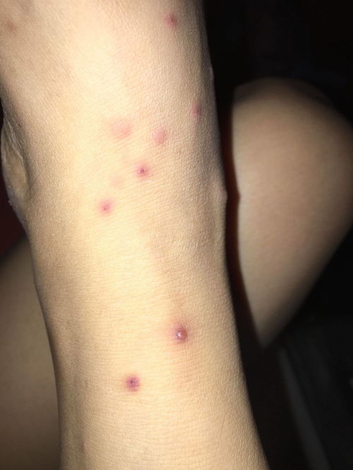 臭虫来袭，轻松应对咬伤的实用指南