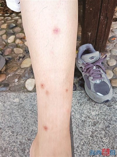 跳蚤咬伤的警示信号，通过症状图片识别和应对