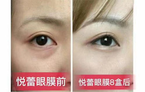 眼睛的隐形警报，揭开慢性角膜炎症状的神秘面纱