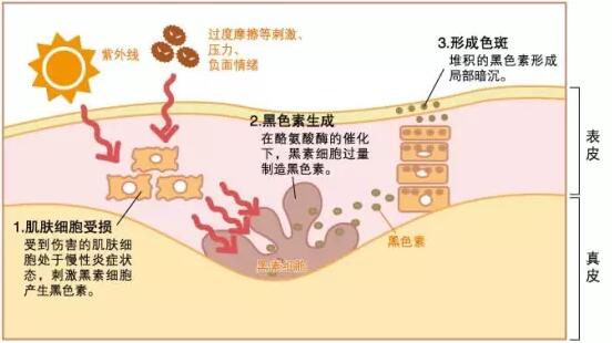 揭秘黑色素沉淀，从成因到防治的全方位解读