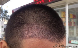 植发可以分期吗？分期植发，轻松变美不等待