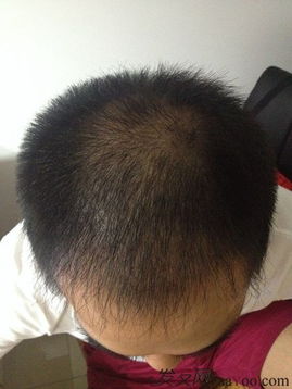 植发可以分期吗？分期植发，轻松变美不等待